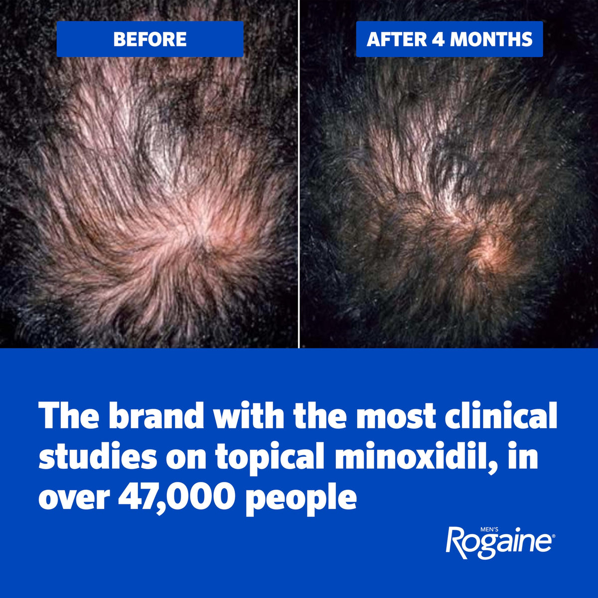 Men’s Rogaine 5% Minoxidil for Men Foam, Clinically Proven Regrowth for Thinning Hair, Topical Hair Loss Treatment, Unscented Topical Aerosol, Results in 8–16 Weeks, 3-Month Supply, 3 x 2.11 oz
